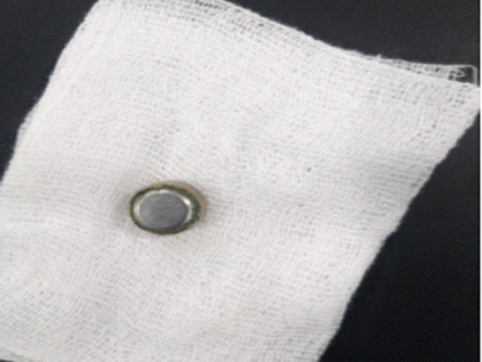 Parents be alert a 9 month old baby swallowed a deadly cell doctors saved his life | पालकांनो सतर्क राहा, ९ महिन्यांच्या बाळाने गिळला जीवघेणा सेल Parents be alert a 9 month old baby swallowed a deadly cell doctors saved his life | पालकांनो सतर्क राहा, ९ महिन्यांच्या बाळाने गिळला जीवघेणा सेल