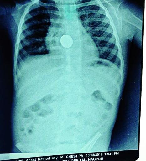 Four-year-old son swallowed cell, a successful operation in the super | चार वर्षीय मुलाने गिळला सेल : ‘सुपर’मध्ये झाली यशस्वी शस्त्रक्रिया
