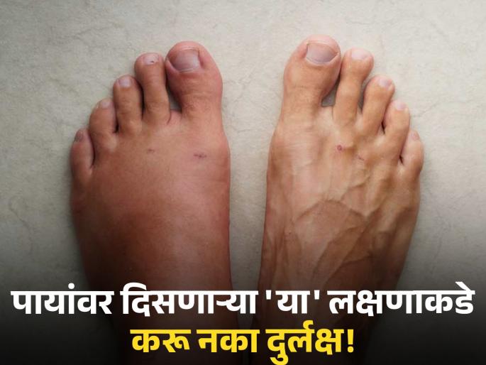Heart Disease : Swelling feet ankles and lower legs is a common sign of heart failure | पायांवर दिसतं हृदयरोगाचं सुरूवातीचं लक्षण, दुर्लक्ष करणं पडू शकतं महागात! Heart Disease : Swelling feet ankles and lower legs is a common sign of heart failure | पायांवर दिसतं हृदयरोगाचं सुरूवातीचं लक्षण, दुर्लक्ष करणं पडू शकतं महागात!