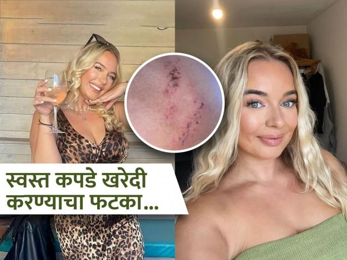 British woman skin got burnt by a shapewear bought from online platform | ऑनलाइन स्वस्त कपडे खरेदी करणं पडलं महागात, कंबर आणि मांडीवर गंभीर इजा; पाहा काय आहे भानगड