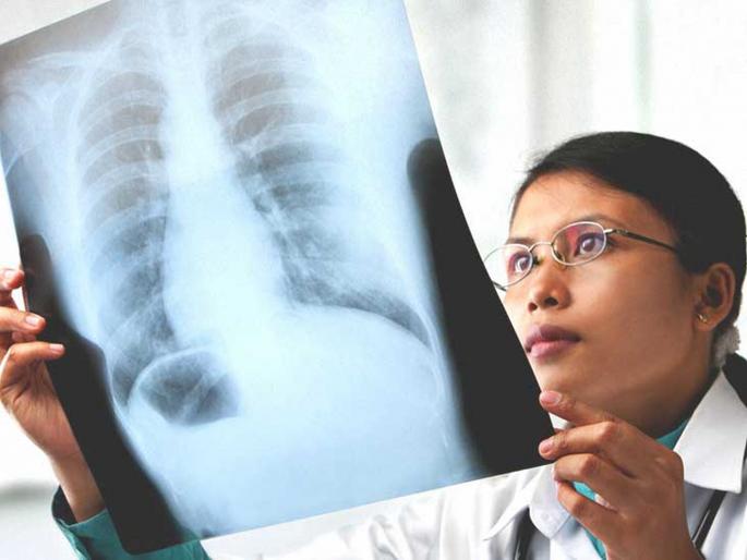 Chest Radiograph can detect when the person dies | चेस्ट रेडिओग्राफने जाणून घेता येईल कधी होणार व्यक्तीचा मृत्यू!