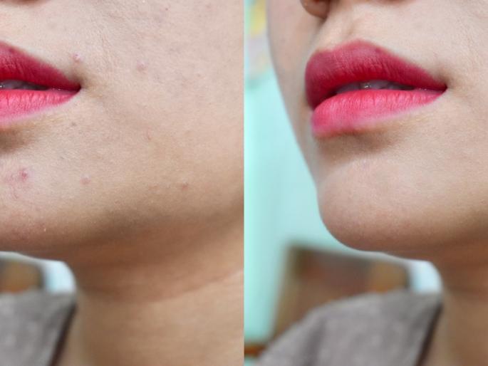 Keratosis pilaris :Isn't your skin 'chicken skin'? If there are fine pimples and blisters on the skin, pay attention. | तुमची त्वचा 'चिकन स्किन' तर नाही? त्वचेवर बारीक पुरळ, फोड येतात, तर लक्ष द्या..