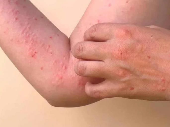 5 cases of chikungunya found, alert in Bhupeshnagar; Survey by Municipal Team | नागपुरात चिकनगुनियाचे ५ रुग्ण आढळले, भूपेशनगरात अलर्ट; मनपाच्या पथकाद्वारे सर्वेक्षण 5 cases of chikungunya found, alert in Bhupeshnagar; Survey by Municipal Team | नागपुरात चिकनगुनियाचे ५ रुग्ण आढळले, भूपेशनगरात अलर्ट; मनपाच्या पथकाद्वारे सर्वेक्षण