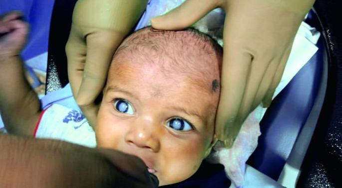 Cataract for a two-month-old baby in Nagpur | नागपुरात दोन महिन्याच्या बाळाला मोतीबिंदू  Cataract for a two-month-old baby in Nagpur | नागपुरात दोन महिन्याच्या बाळाला मोतीबिंदू