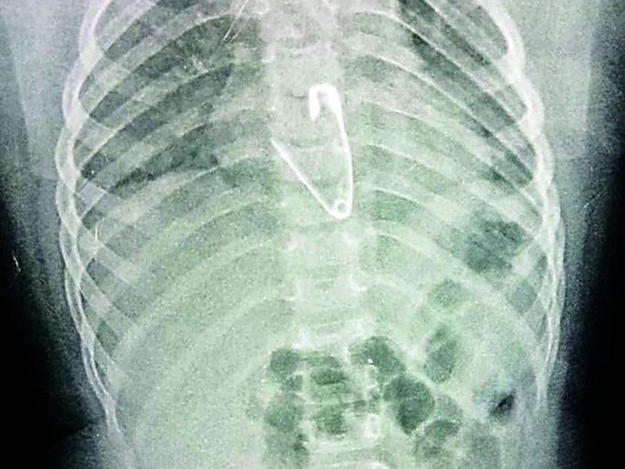 Child girl engulp Pin : A successful operation in Nagpur's 'Super' | चिमुकलीने गिळली पिन : नागपूरच्या ‘सुपर’मध्ये यशस्वी शस्त्रक्रिया