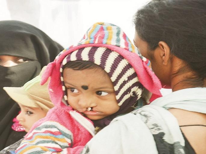 free facial n Fractured lips surgery in Aurangabad | दुभंगलेले ओठ, चेहऱ्यावरील व्रणाची मोफत शस्त्रक्रिया free facial n Fractured lips surgery in Aurangabad | दुभंगलेले ओठ, चेहऱ्यावरील व्रणाची मोफत शस्त्रक्रिया