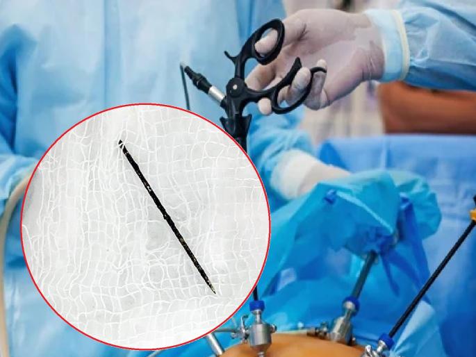 The surgery was for the testicles, but the doctor was shocked to find a needle in the toddler's thigh | शस्त्रक्रिया अंडकोशाची, पण चिमुकल्याच्या जांघेत सुई सापडल्याने डाॅक्टर थक्क The surgery was for the testicles, but the doctor was shocked to find a needle in the toddler's thigh | शस्त्रक्रिया अंडकोशाची, पण चिमुकल्याच्या जांघेत सुई सापडल्याने डाॅक्टर थक्क