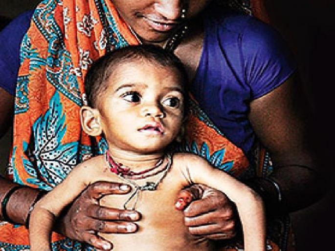 Underweight students of neglected classes, study in urban areas and conclude | कमी वजनाची मुले उपेक्षित वर्गातीलच, शहरी भागातील अभ्यासाअंती निष्कर्ष Underweight students of neglected classes, study in urban areas and conclude | कमी वजनाची मुले उपेक्षित वर्गातीलच, शहरी भागातील अभ्यासाअंती निष्कर्ष