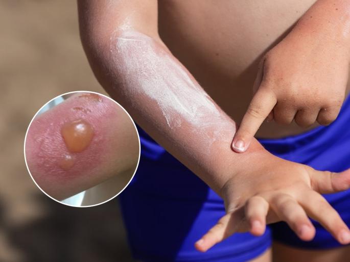 quick home remedies for child hand burn how to reduce burning sensation after burn naturally | मुलांचा हात भाजला- चटका बसला? पटकन करा ४ उपाय - आग होईल कमी