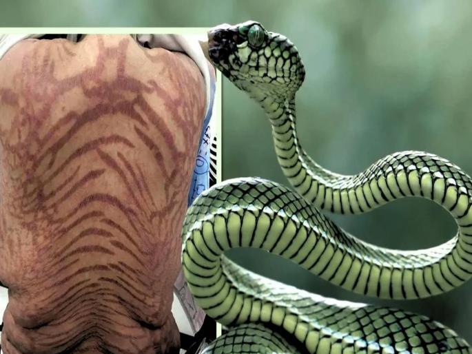 Shocking! Woman bought cream online, got snake-like ulcers on her body; spent Rs 12 lakh in 10 years | धक्कादायक! ऑनलाइन क्रीम खरेदी केली, महिलेच्या शरीरावर सापासारखे व्रण; १० वर्षांत १२ लाख रुपये खर्च Shocking! Woman bought cream online, got snake-like ulcers on her body; spent Rs 12 lakh in 10 years | धक्कादायक! ऑनलाइन क्रीम खरेदी केली, महिलेच्या शरीरावर सापासारखे व्रण; १० वर्षांत १२ लाख रुपये खर्च