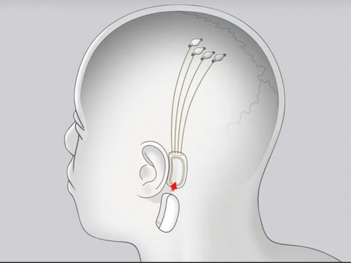 Elon Musk is making implants to link the brain with a smartphone | आता स्मार्टफोनने कंट्रोल होणार मनुष्याचा मेंदू, 'या' लोकांवर होणार फ्लेक्सिबल चीपचा वापर! Elon Musk is making implants to link the brain with a smartphone | आता स्मार्टफोनने कंट्रोल होणार मनुष्याचा मेंदू, 'या' लोकांवर होणार फ्लेक्सिबल चीपचा वापर!