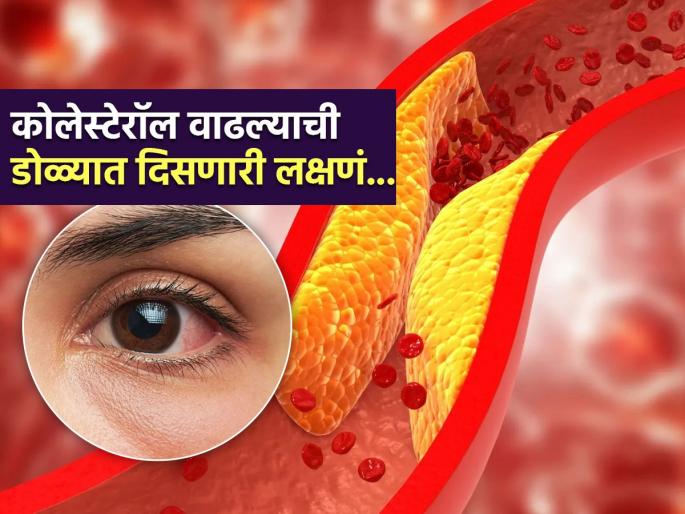 These 4 symptoms are seen in the eyes can be sign of high cholesterol level | डोळ्यांमध्ये पिवळे-लाल ठिपके दिसतात, सूजही आहे? उठा आणि लगेच करा कोलेस्टेरॉलची टेस्ट
