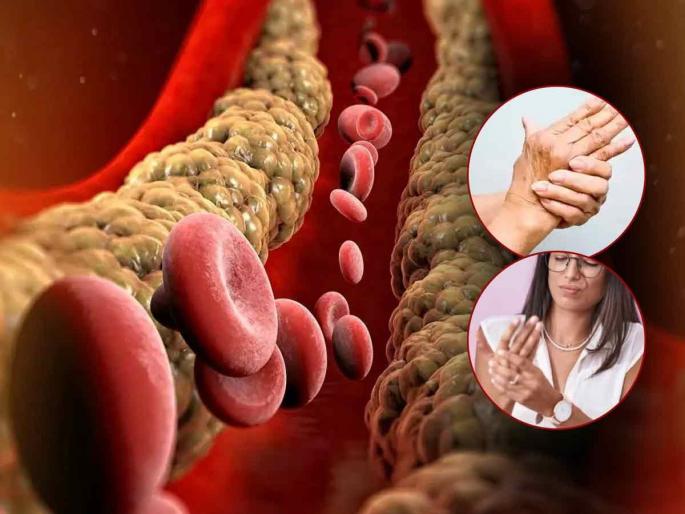 High cholesterol signs in fingers and legs | शरीरात बॅड कोलेस्टेरॉल वाढल्यावर बोटांवर दिसतात 'ही' लक्षणं, वेळीच ओळखा आणि निरोगी रहा!