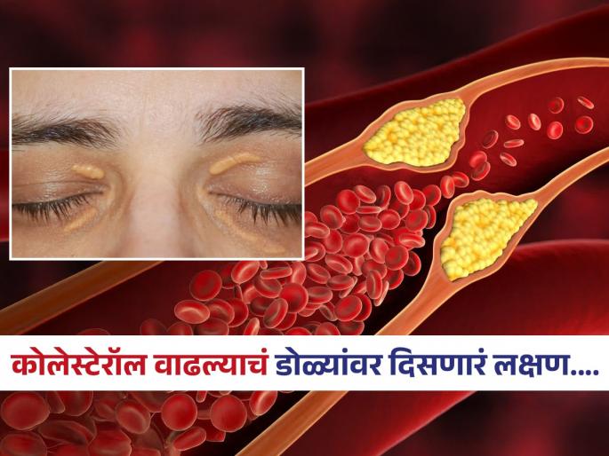 These are the high cholesterol symptoms seen in the eyes | डोळ्यांमध्ये दिसणारा 'हा' बदल म्हणजे कोलेस्टेरॉल वाढल्याचं लक्षण, हयगय केली तर जीवाला धोका
