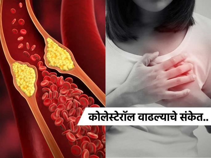 Hidden symptoms of high cholesterol level | कोलेस्टेरॉल वाढलं तर कळतंही नाही, पाहा काय असतात बॅड कोलेस्टेरॉल वाढल्याचे काही घातक संकेत