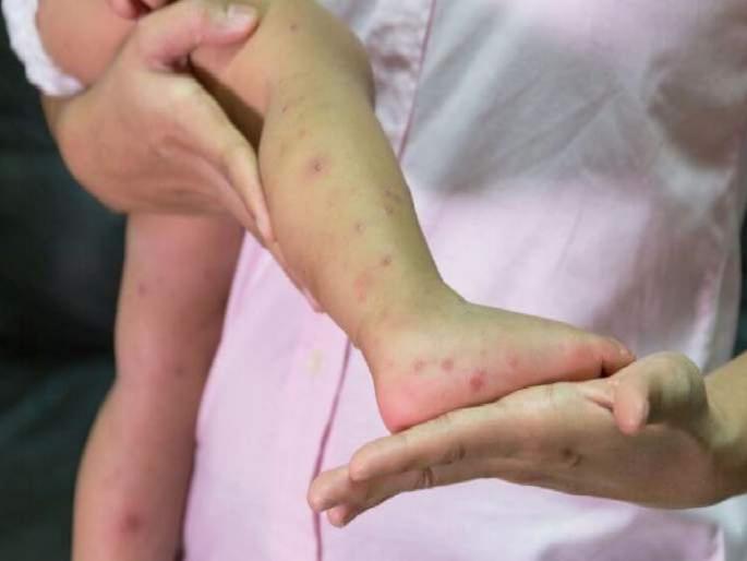 Measles patients under control number of patients stabilized in thane | गोवर रुग्ण आटोक्यात, रुग्ण संख्या स्थिरावली Measles patients under control number of patients stabilized in thane | गोवर रुग्ण आटोक्यात, रुग्ण संख्या स्थिरावली