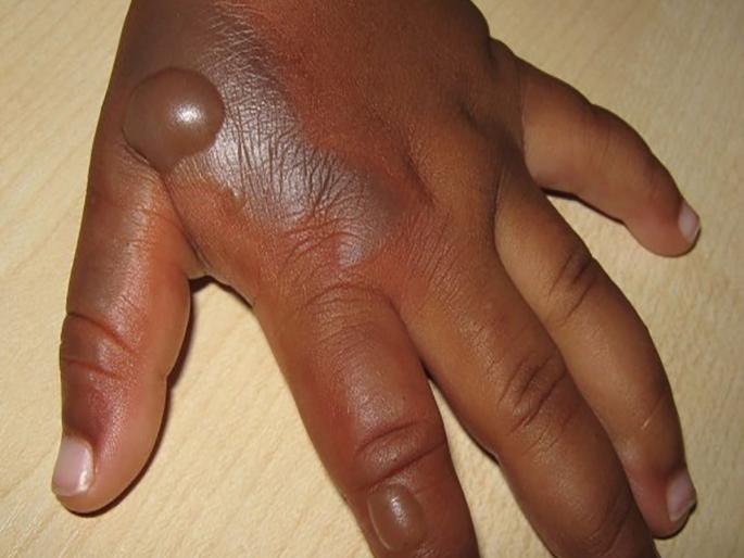 A one-and-a-half-year-old baby got burned after putting his hand in hot water while playing | खेळता खेळता गरम पाण्यात हात घातल्यानं दीड वर्षाचं बाळ भाजलं