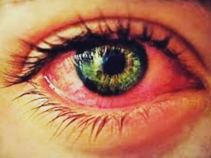 Changes in the environment have increased the number of eye conjunctivitis in mumbai | वातावरणातील बदलामुळे डोळे येण्याचे प्रमाण वाढले, डॉक्टरांनी दिला असा सल्ला Changes in the environment have increased the number of eye conjunctivitis in mumbai | वातावरणातील बदलामुळे डोळे येण्याचे प्रमाण वाढले, डॉक्टरांनी दिला असा सल्ला