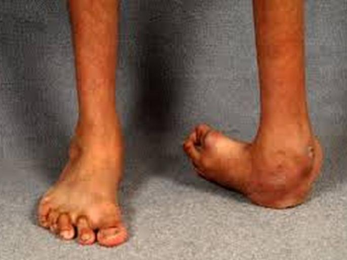 clubfoot patients will be find through anganwadi | अंगणवाडीच्या माध्यमातून घेतला जाईल क्लबफूट रुग्णांचा शोध! clubfoot patients will be find through anganwadi | अंगणवाडीच्या माध्यमातून घेतला जाईल क्लबफूट रुग्णांचा शोध!