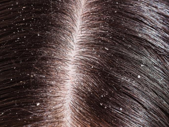 Are you troubled with the problem of Dandruff? | डॅँड्रफच्या समस्येने त्रस्त आहात? Are you troubled with the problem of Dandruff? | डॅँड्रफच्या समस्येने त्रस्त आहात?