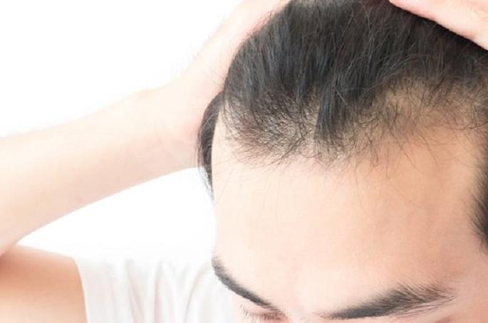 Beauty: 'This remedy will become bald, new case will come away!' | Beauty : ​‘या’ एका उपायाने टक्कल होईल दूर, येतील नवे केस !