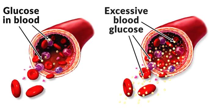 HEALTH: How will blood sugar levels be identified? | HEALTH : ​रक्तातील साखरेची पातळी कशी ओळखाल?