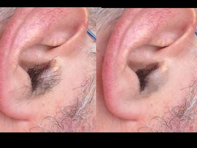 Hair Loss Disease | कानावर केस जीवघेणे आजार Hair Loss Disease | कानावर केस जीवघेणे आजार