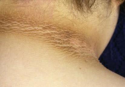 To get the banana kale ... | ​मानेचे काळेपण घालविण्यासाठी...