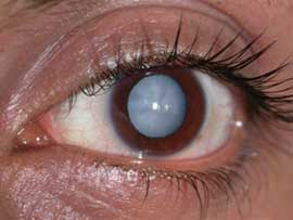 New drug to remove cataracts | मोतीबिंदू घालवण्यासाठी नवे औषध