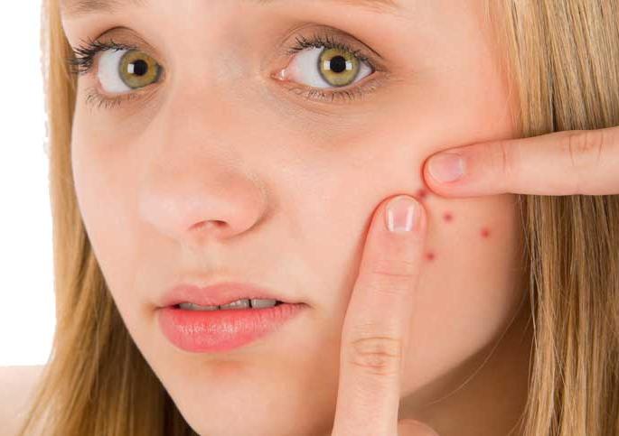 Pimples are due to this reason! | या कारणाने होतात पिंंपल्स !