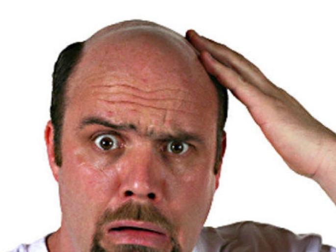 Smart Tips: Baldness? Do not be disappointed, if you follow these tips, then smart smart! | Smart Tips : टक्कल पडलीय? निराश होऊ नका, ‘या’ टिप्स फॉलो केल्यास दिसाल स्मार्ट !