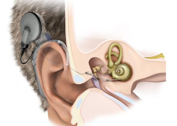Five more children in Nagpur hearing defect away | नागपुरात आणखी पाच चिमुकल्यांचे श्रवणदोष दूर! Five more children in Nagpur hearing defect away | नागपुरात आणखी पाच चिमुकल्यांचे श्रवणदोष दूर!
