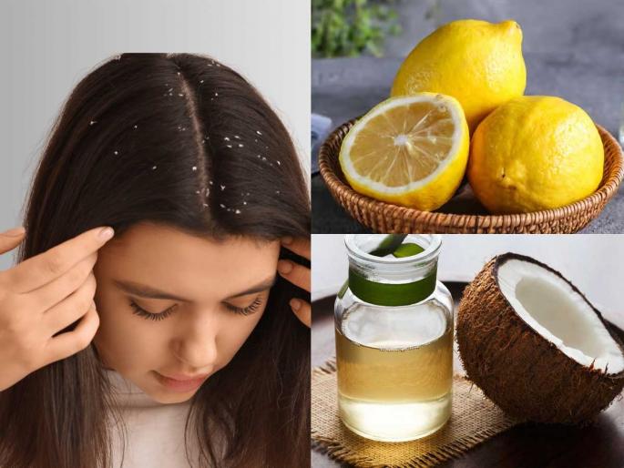 Coconut Oil & Lemon Juice Use to Reduce Dandruff coconut oil and lemon for dandruff reduce dandruff naturally | हिवाळ्यात कोंडा इतका वाढला, खांद्यावर पडतो? खोबरेल तेलात मिसळा १ पदार्थ - कोंडा कायमचा जाईल...