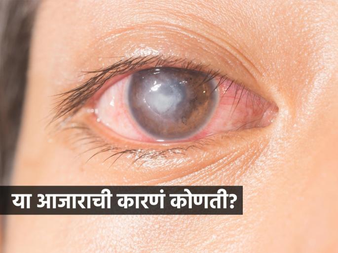 corneal blindness is increasing in young people, what is corneal blindness? symptoms and causes of corneal blindness | बाप रे! ऐन तारुण्यात अवघ्या तिशीतच तरुणांना येतंय अंध्यत्व, कॉर्नियल ब्लाइंडनेसची पाहा लक्षणं..
