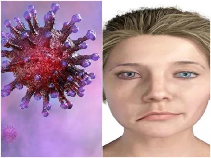 coronavirus patients new symptoms of bells palsy American study people need to take care | काळजी वाढली : कोरोना रुग्णांमध्ये 'या' आजाराचा धोका सातपट; अमेरिकेतील संशोधनातून माहिती समोर coronavirus patients new symptoms of bells palsy American study people need to take care | काळजी वाढली : कोरोना रुग्णांमध्ये 'या' आजाराचा धोका सातपट; अमेरिकेतील संशोधनातून माहिती समोर
