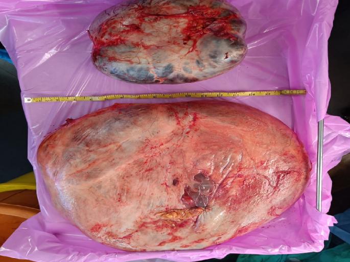 Two tumors of 9 kg were removed from woman stomach, free surgery was done at CPR in Kolhapur | महिलेच्या पोटातून ९ किलोच्या दोन गाठी काढल्या, कोल्हापुरातील सीपीआरमध्ये झाली मोफत शस्त्रक्रिया Two tumors of 9 kg were removed from woman stomach, free surgery was done at CPR in Kolhapur | महिलेच्या पोटातून ९ किलोच्या दोन गाठी काढल्या, कोल्हापुरातील सीपीआरमध्ये झाली मोफत शस्त्रक्रिया