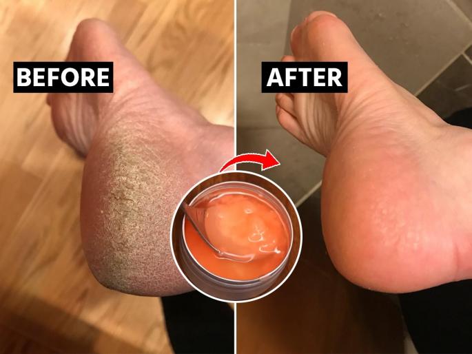 Cracked Heels Home Remedy How to heal cracked heels in winters Candle Wax For Cracked Heels | चमचाभर खोबरेल तेल, २ मेणबत्त्या वापरुन करा पायांच्या भेगांवर असरदार उपाय - भेगाळलेल्या टाचाही होतील मऊमुलायम... Cracked Heels Home Remedy How to heal cracked heels in winters Candle Wax For Cracked Heels | चमचाभर खोबरेल तेल, २ मेणबत्त्या वापरुन करा पायांच्या भेगांवर असरदार उपाय - भेगाळलेल्या टाचाही होतील मऊमुलायम...