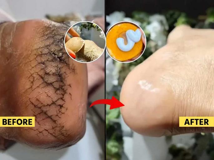 Cracked Heels Home Remedies home remedies for cracked heels cracked heel treatment at home dry cracked heels remedy natural remedies for cracked heels | भेगाळलेल्या टाचांवर स्वयंपाक घरातील ३ पदार्थ असरदार! रोज करा मालिश - टाचा होतील मऊ - मुलायम...