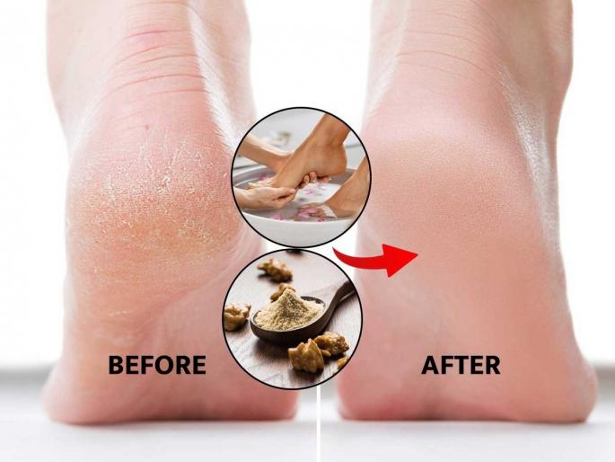 Cracked heels? A seemingly common problem turns out to be dangerous, see simple home remedies | पायाला सारख्या भेगा पडतात? सामान्य वाटणारी समस्या ठरेल धोक्याची, पाहा सोपे घरगुती उपाय Cracked heels? A seemingly common problem turns out to be dangerous, see simple home remedies | पायाला सारख्या भेगा पडतात? सामान्य वाटणारी समस्या ठरेल धोक्याची, पाहा सोपे घरगुती उपाय