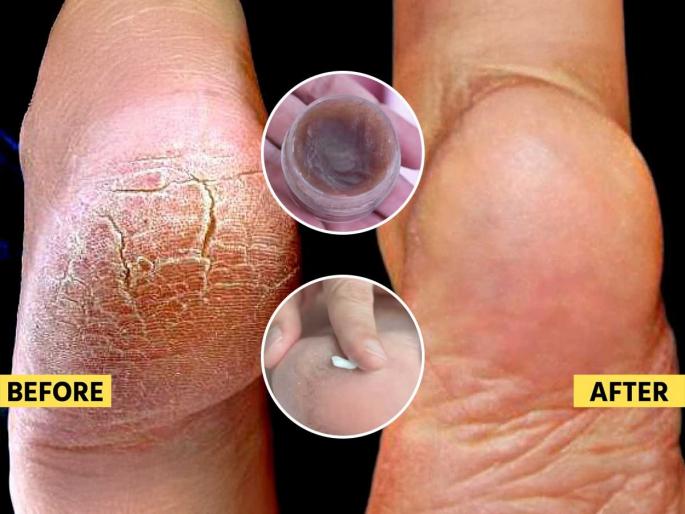 how to heal deep cracked heels in winter naturally simple home remedy using wax for cracked heels winter dryness foot care tips for women best DIY treatment to repair heel cracks at Home | हिवाळ्यात टाचांना भेगा पडल्या- चालता येत नाही? मेणात कालवा ४ गोष्टी, सोपा उपाय - भेगा होतील कमी