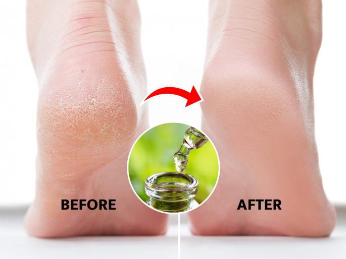 how to heal cracked heels naturally at Home glycerin and natural ingredient for soft heels best home remedy for painful cracked heels | टाचांच्या भेगा खूप वाढल्या, चालताना दुखते? ग्लिसरीनमध्ये मिसळून लावा १ पदार्थ- टाचा होतील मऊ