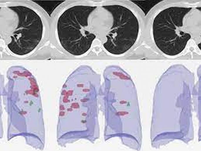 CT Scan scores of RTPCR negative patients are also worrisome | आरटीपीसीआर निगेटिव्ह रुग्णांचाही सीटी स्कोअर चिंताजनक CT Scan scores of RTPCR negative patients are also worrisome | आरटीपीसीआर निगेटिव्ह रुग्णांचाही सीटी स्कोअर चिंताजनक