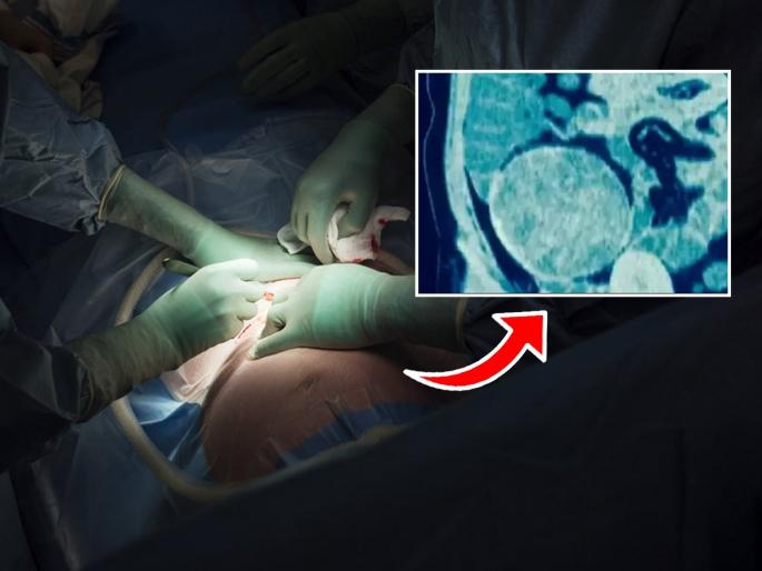 New Delhi women rare case of 8 inch cyst caused by retained surgical sponge emergency C‑section complication | चार वर्षे सोसल्या पोटदुखीच्या असह्य वेदना, सिझेरियन करताना डॉक्टरांकडून झाली मोठी चूक-पोटात सापडलं भलतंच..
