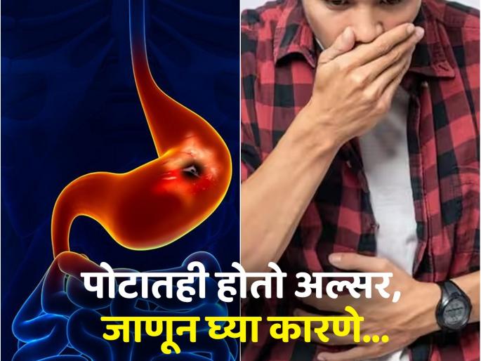 Stomach ulcer causes, symptoms and tips to avoid it | तोंडाचा अल्सर माहीत असेलच, आता पोटाच्या अल्सरची लक्षणे, कारणे अन् बचावाचे उपाय वाचा!