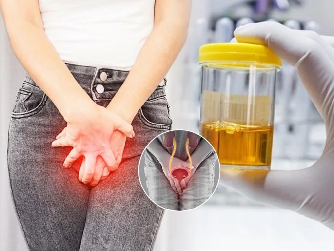 Expert Advice About Urine Infection In Summer : Urinary fire, burning due to summer? Experts give valuable advice. | उन्हाळी लागल्याने लघवीला भयंकर आग, जळजळ होते? तज्ज्ञ देतात फार मोलाचा सल्ला..