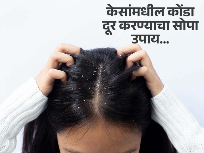 Dermatologist tells how to get rid of dandruff with apple cider vinegar | केसांमध्ये अडकून बसलाय चिवट, चिकट कोंडा? करा एक असा उपाय जो कायमची सोडवेल समस्या