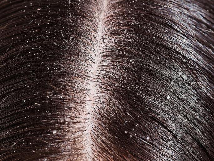 Tomato juice to fight hair dandruff | टोमॅटोने डॅंड्रफपासून लगेच मिळवा सुटका, जाणून घ्या कसा कराल वापर? Tomato juice to fight hair dandruff | टोमॅटोने डॅंड्रफपासून लगेच मिळवा सुटका, जाणून घ्या कसा कराल वापर?
