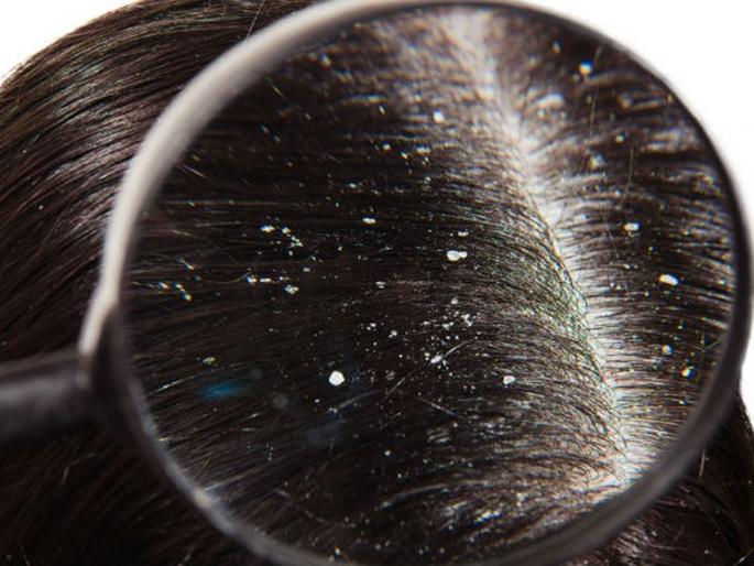 Skin disorders due to strains in Kisas | केसातील कोंड्यांमुळे त्वचेचा आजार Skin disorders due to strains in Kisas | केसातील कोंड्यांमुळे त्वचेचा आजार