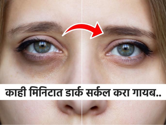 Home remedies to remove dark circles under eyes naturally | डोळ्याखालच्या काळ्या वर्तुळांमुळे चेहरा निस्तेज-म्हातारा दिसतो? ४ उपाय-काही दिवसात डार्क सर्कल गायब