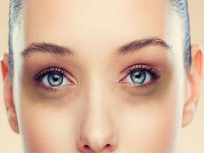 Milk is the best cream for dark circles | डार्क सर्कल दूर करण्यासाठी 'हा' स्वस्तात मस्त घरगुती उपाय कराल, तर महागड्या क्रिमचा खर्च वाचेल! Milk is the best cream for dark circles | डार्क सर्कल दूर करण्यासाठी 'हा' स्वस्तात मस्त घरगुती उपाय कराल, तर महागड्या क्रिमचा खर्च वाचेल!